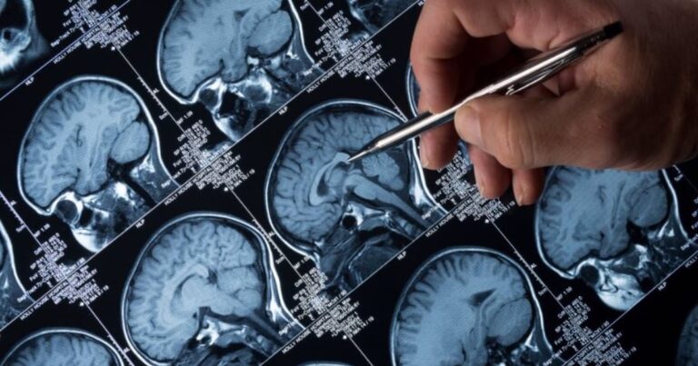 En torno a un 20% de los pacientes con epilepsia desarrollan ansiedad o depresión