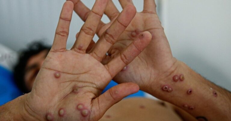 Registran en Argentina el primer caso de la cepa más agresiva y contagiosa de la «viruela del mono»